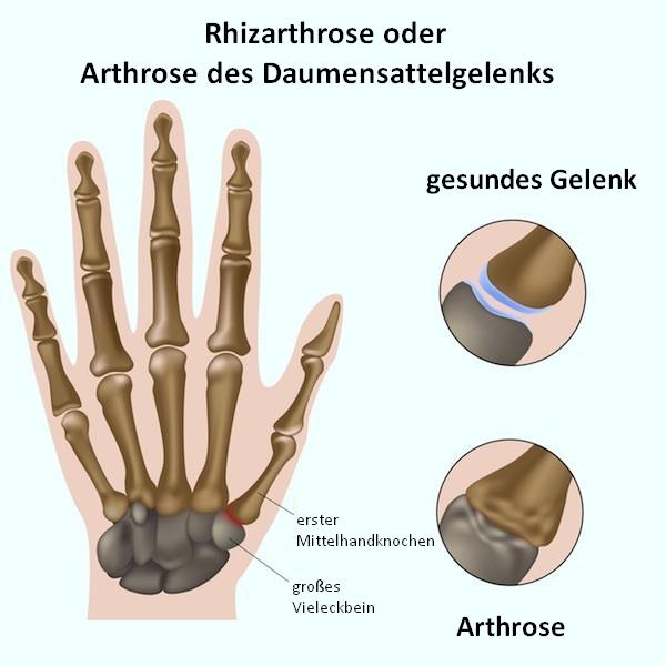 Arthrose in den Fingern