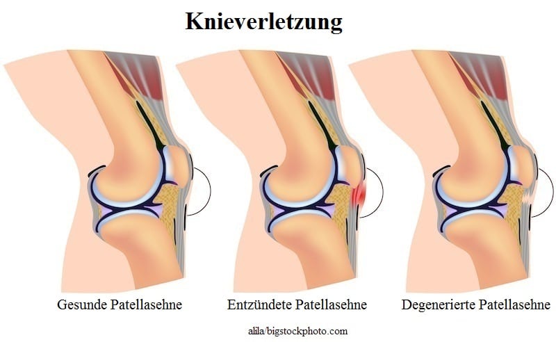 Sehnenentzündung im Knie,Patellasehne
