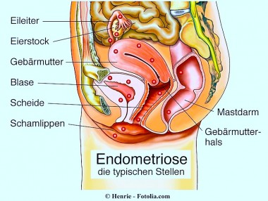 Endometriose,weibliche Geschlechtsorgane