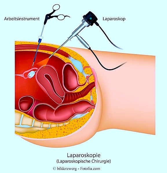 Laparoskopie,Bauchspiegelung