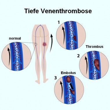Thrombose,Venen,tiefe,Embolus,Implantation,Immobilisation,Prothese