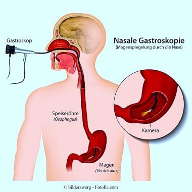 nasale magenspiegelung, Gastroskopie