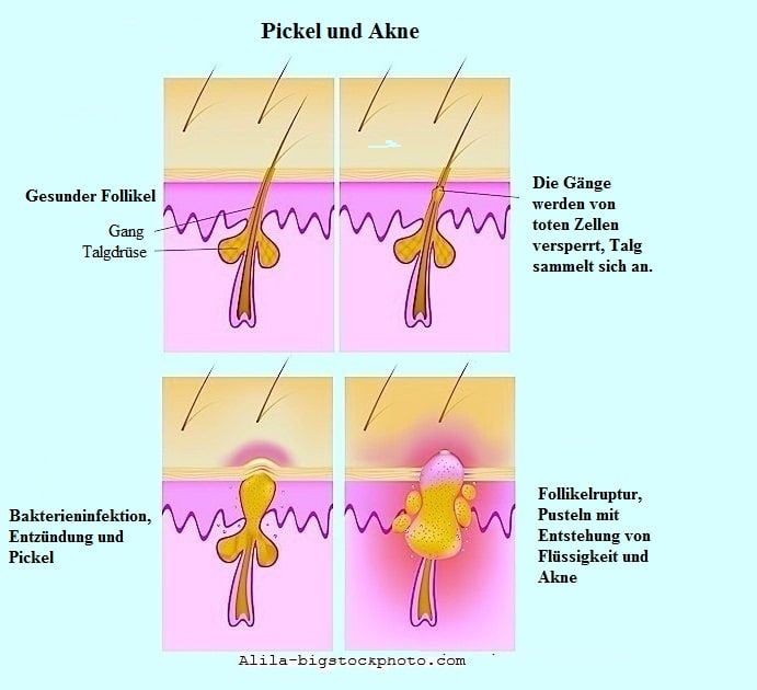 bigstock-Formation-of-skin-acnes-and-pi-Alila