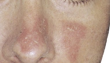 Seborrhoische Dermatitis