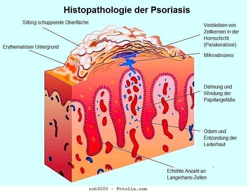 Psoriasis,Symptome,wie sie sich manifestiert