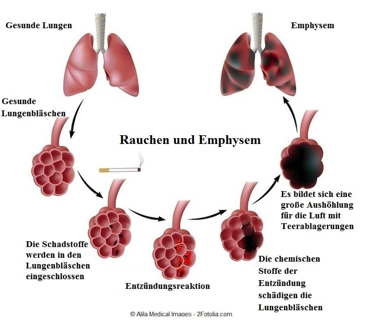 Lungenemphysem,Phasen,Stadium,Alveole,Rauchen