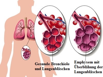 Emphysem,Lunge,Rauch,Alveolen