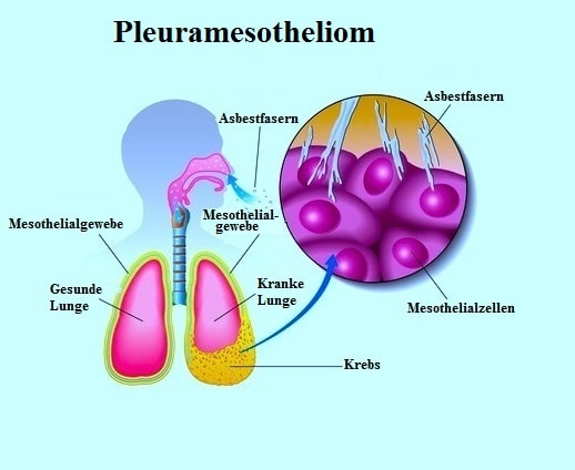 Pleuramesotheliom,pulmonal
