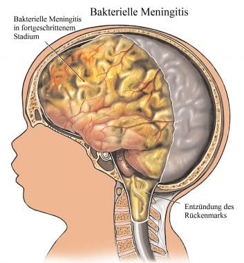Bakterielle-Meningitis-Hirn-Schädel