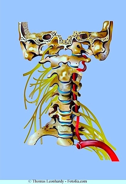 Arterie,vertebralis,zervikal,Arthrose