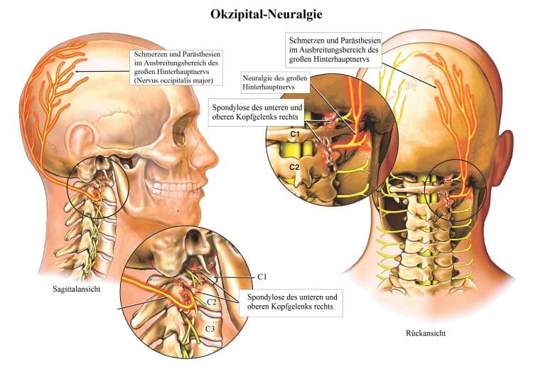 Okzipital-Neuralgie-Hinterhauptnerv-Parästhie