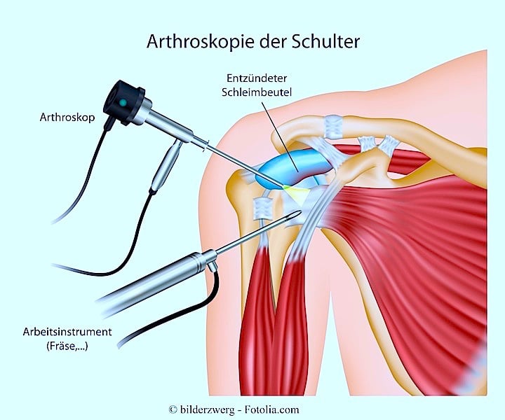 arthroskopie,Schulter