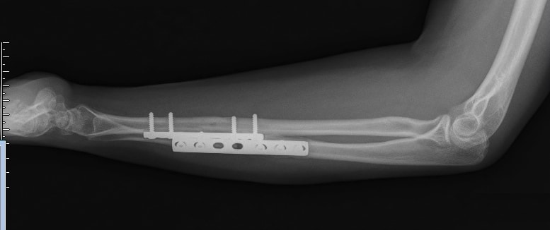 Fraktur,Unterarm,Ellenbogen,rechts,Sudeck’sche Dystrophie,Röntgenaufnahme