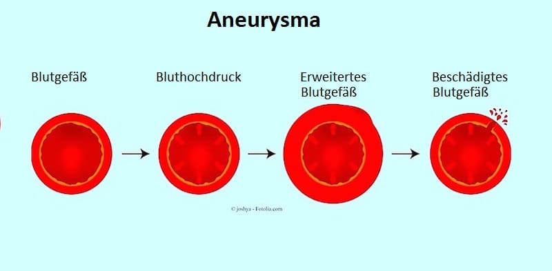 Aneurysma,Bluthochdruck