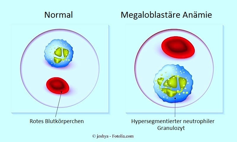 Megaloblastäre Anämie,rot,Blutkörperchen