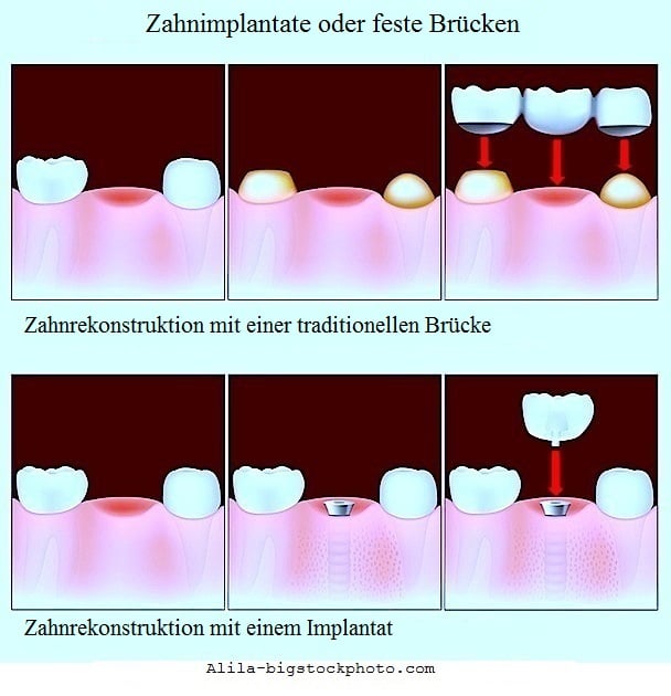Dentales Granulom,Implantat,Brücke