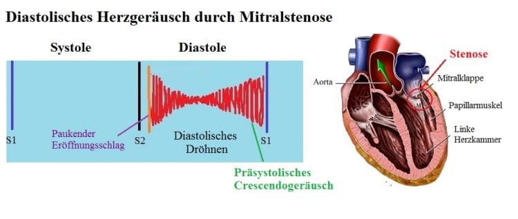 Diastolisches-HerzgerÑusch-Mitralstenose