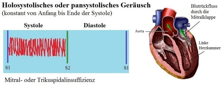 Pansystolisches-HerzgerÑusch