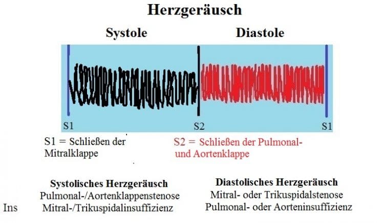 Systolisches-diastolisches-HerzgerÑusch