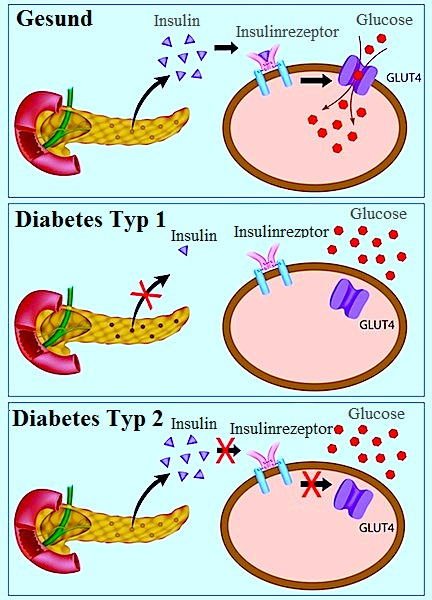Symptome bei Diabetes