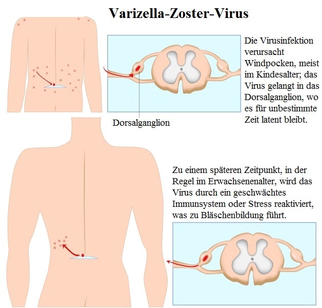 Varizella-Zoster-Virus,Ganglion,Immunsystem