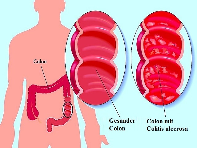 Colitis ulcerosa - Symtome Naturheilmittel und Operation