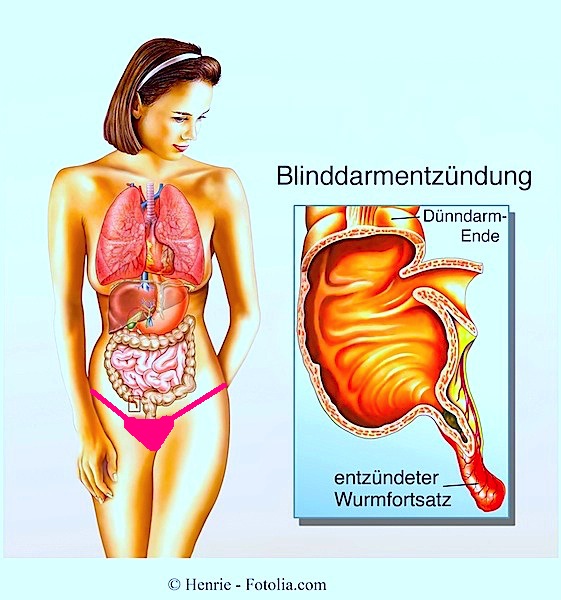Symptome der Blinddarmentzündung und chirurgischer Eingriff