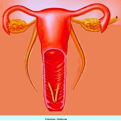 Unregelmäßige Menstruation - Ursachen Symptome und Therapie