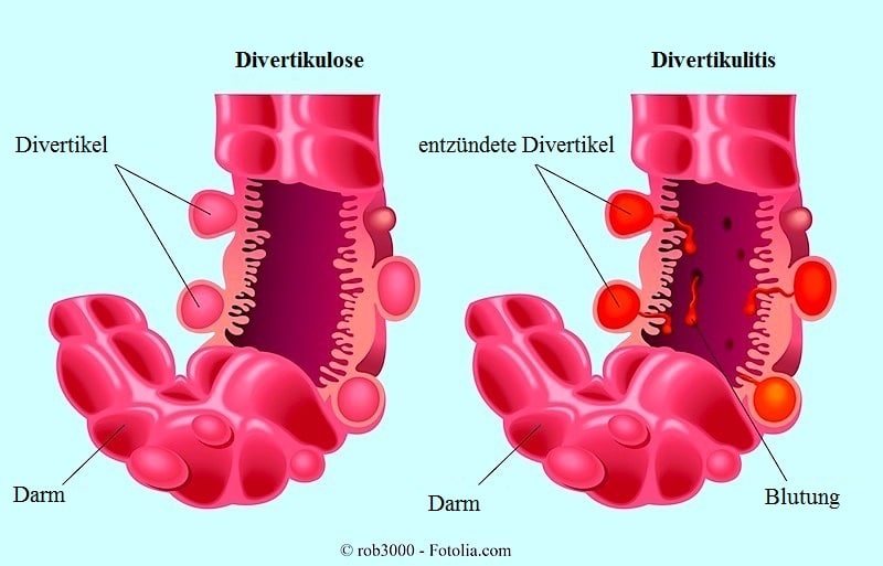 Divertikulitis und Divertikulose