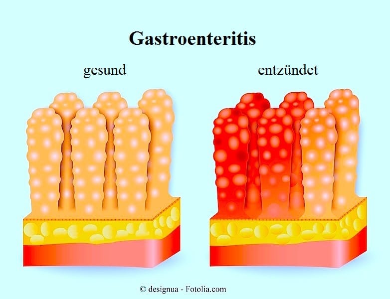 Gastroenteritis oder Magen-Darm-Grippe
