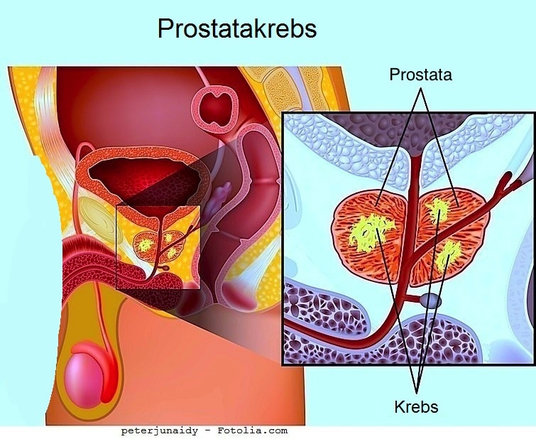 Aggressiver prostatakrebs
