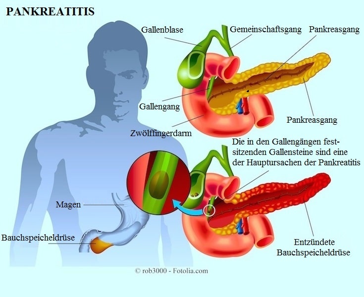 Akute und chronische Pankreatitis