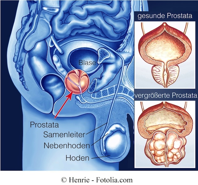 A férfiakban a prostatitis befolyásolja Maestro a prosztatitisből