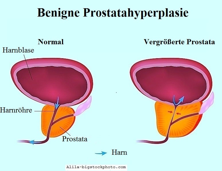 Prostatitis,Prostatavergrößerung,benigne Hypertrophie