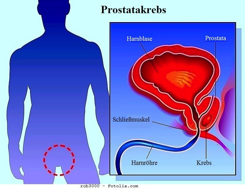 Prostatakrebs