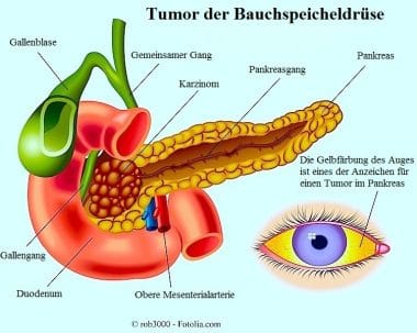 Tumor-der-Bauchspeicheldrüse