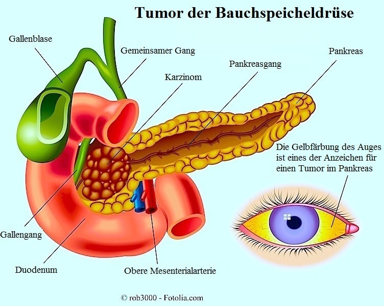 Tumor,Bauchspeicheldrüse,Pankresagang