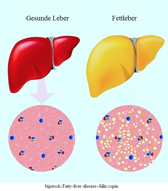 Fettleber oder Steatosis hepatis