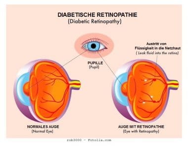 Diabetische Retinopathie,Blut,Blutung,Sehvermögen