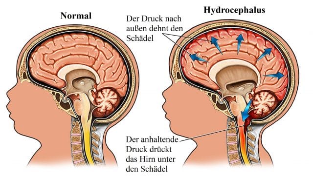 Hydrocephalus-Druck-Schädel-Hirn