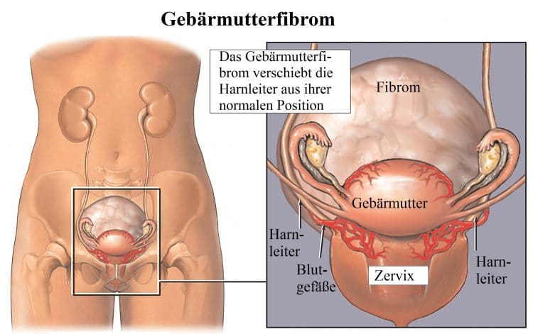 Fibrom, Gebärmutter, Uterus, Frau, Fruchtbarkeit, Unfruchtbarkeit