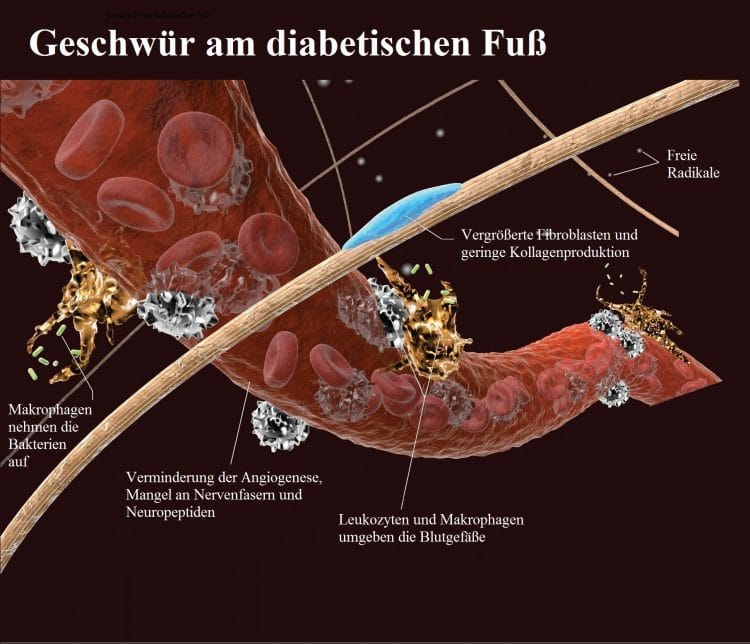 Geschwür-Diabetischer-Fuß-Angiogenese