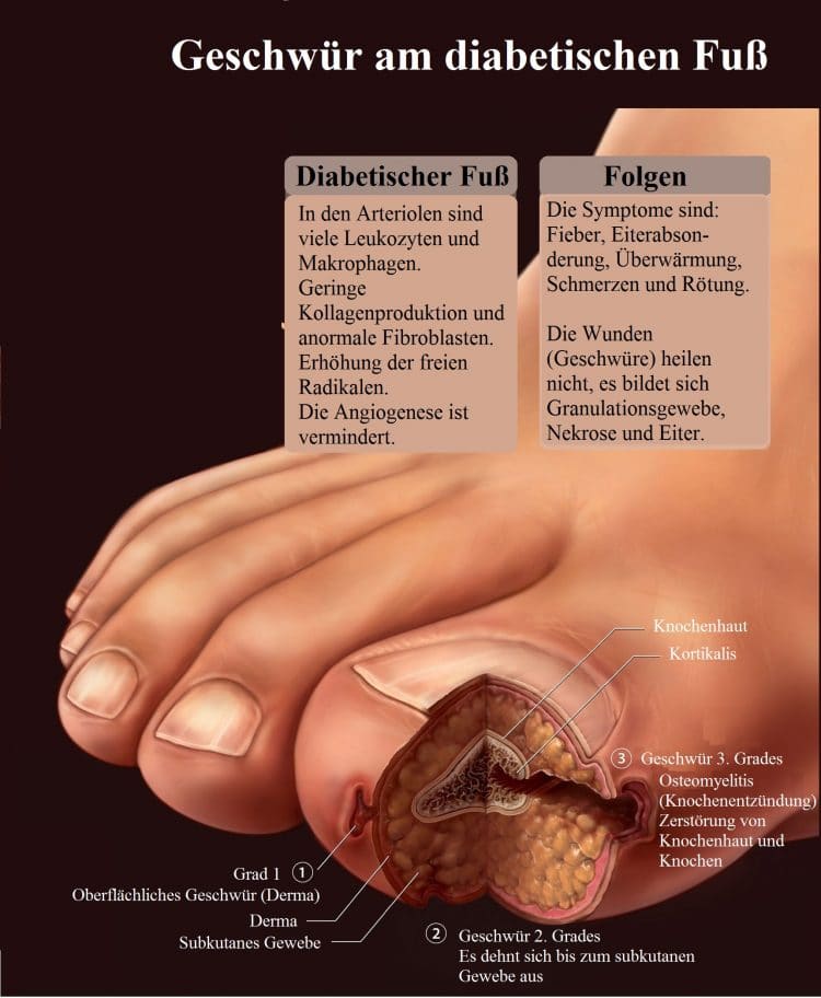 Geschwür-Diabetischer-Fuß-Folgen