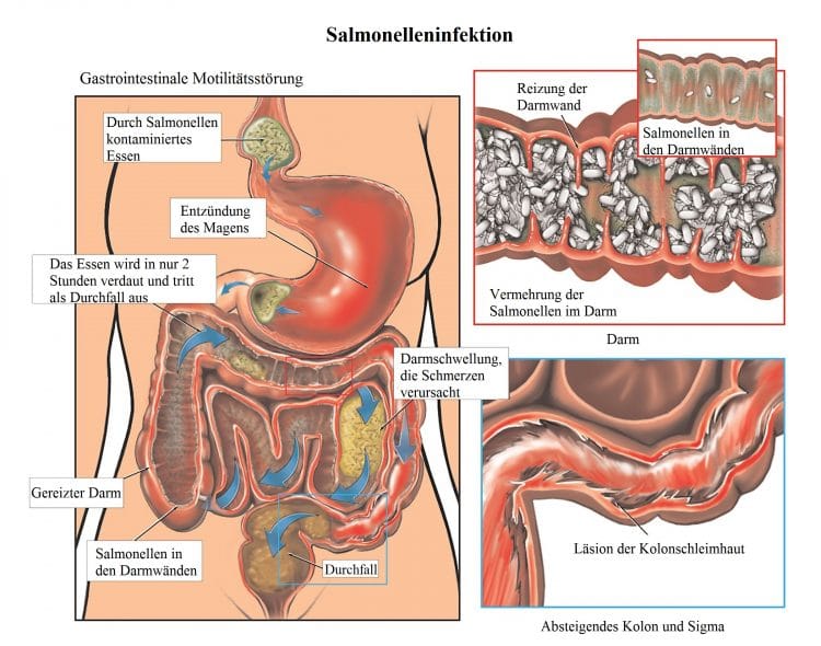 Salmonelleninfektion-Darm-Magen-Durchfall