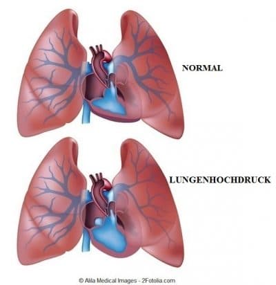 Pulmonale-arterielle-Hypertonie
