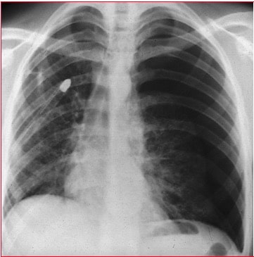 Pneumothorax links,Trachea, Herz rechts