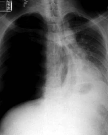 Spannungspneumothorax, Lungenkollaps, Kompression, Herz