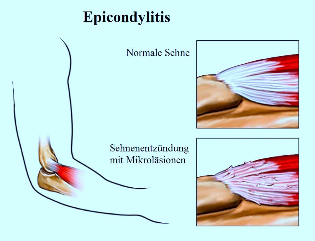 Epicondylitis