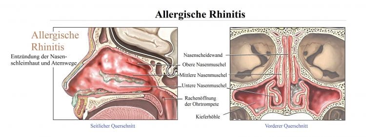 Allergische, Rhinitis, Entzündung, Nasenschleimhaut