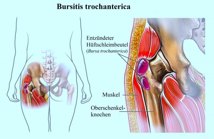 Bursitis trochanterica, Schleimbeutel